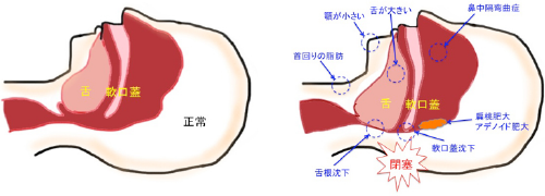 が かすれる 声 痰 絡む が